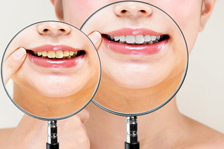 ホワイトニングで歯を美しく笑顔に自信を。審美歯科の当院でより白く輝く歯に